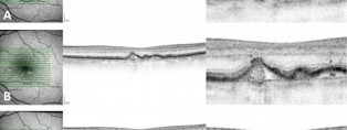 Identificació mitjançant SD-OCT d’una drusa que comença el procés d’atròfia. A) S’observa una drusa sense irregularitats, però amb hiper-reflectivitat en el RPE superposat. B) El RPE mostra irregularitats i punts hiper-reflectius per sobre. C) Els danys en el RPE són més evidents amb la presència de punts iso-reflectius — el drusen ooze.