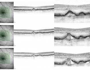 Identificació mitjançant SD-OCT d’una drusa que comença el procés d’atròfia. A) S’observa una drusa sense irregularitats, però amb hiper-reflectivitat en el RPE superposat. B) El RPE mostra irregularitats i punts hiper-reflectius per sobre. C) Els danys en el RPE són més evidents amb la presència de punts iso-reflectius — el drusen ooze.