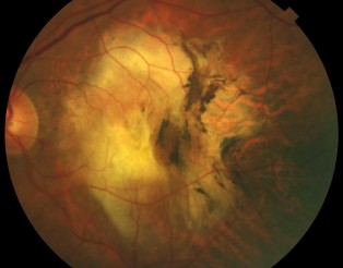 DMAE exudativa (JM El Periodico) RGB