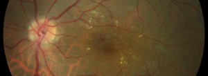 RD edema macular
