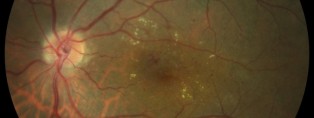 Edema macular diabético